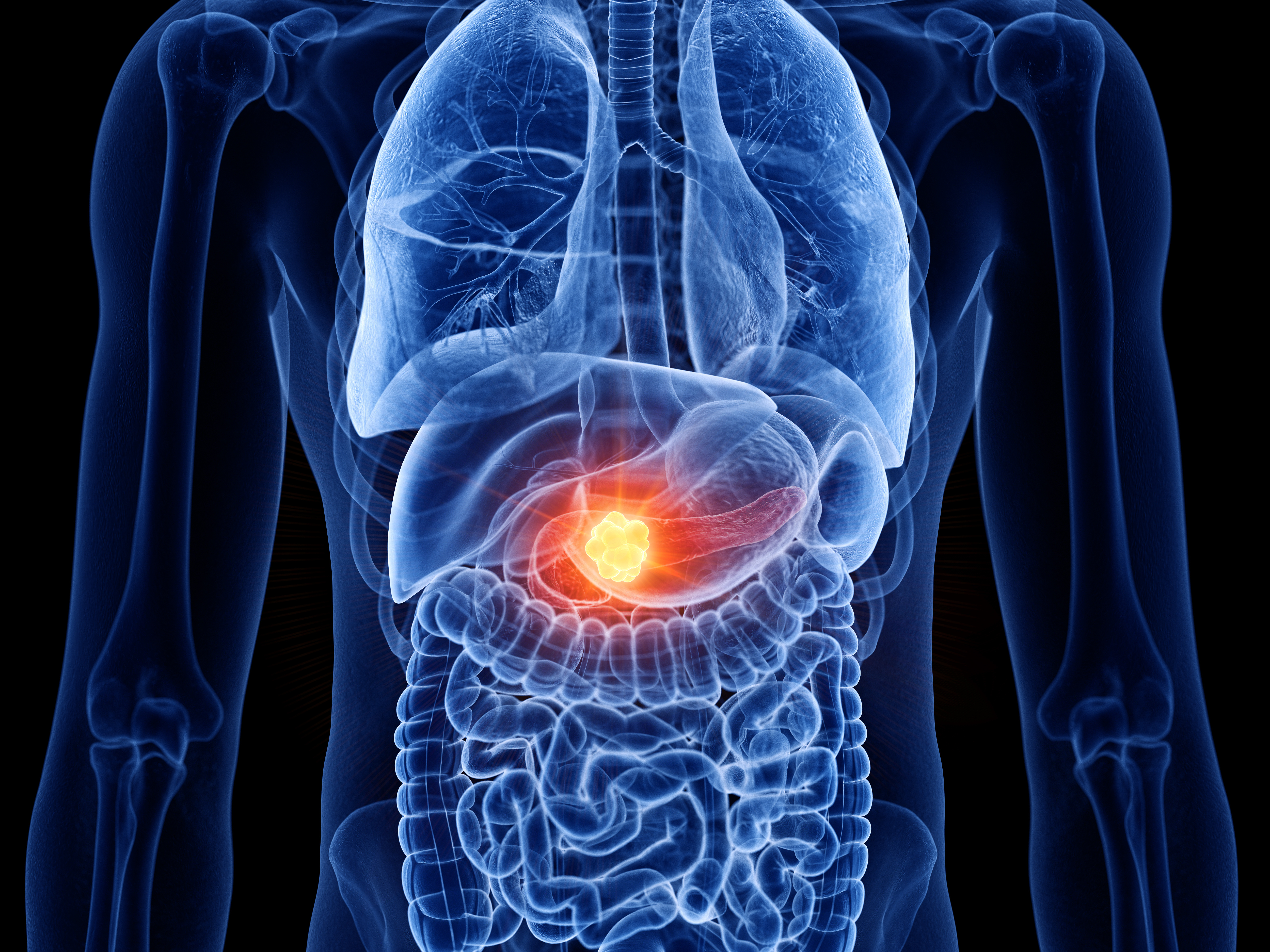 早期発見されにくい！膵がん診断の難しさ、注意すべき症状について